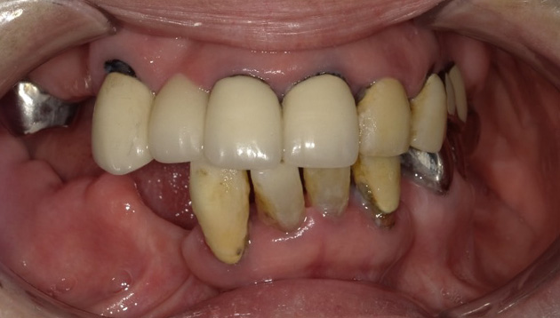 上下全顎インプラント治療症例