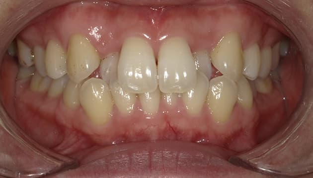 上下非抜歯マウスピース矯正症例