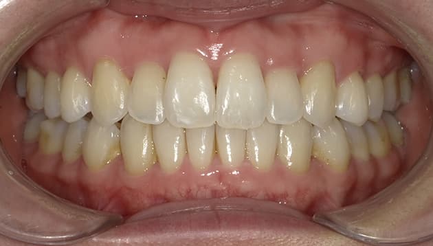 上下非抜歯マウスピース矯正症例