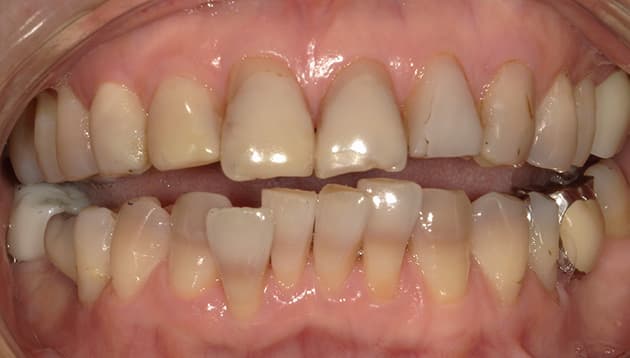 全顎審美治療症例