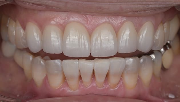 全顎審美治療症例
